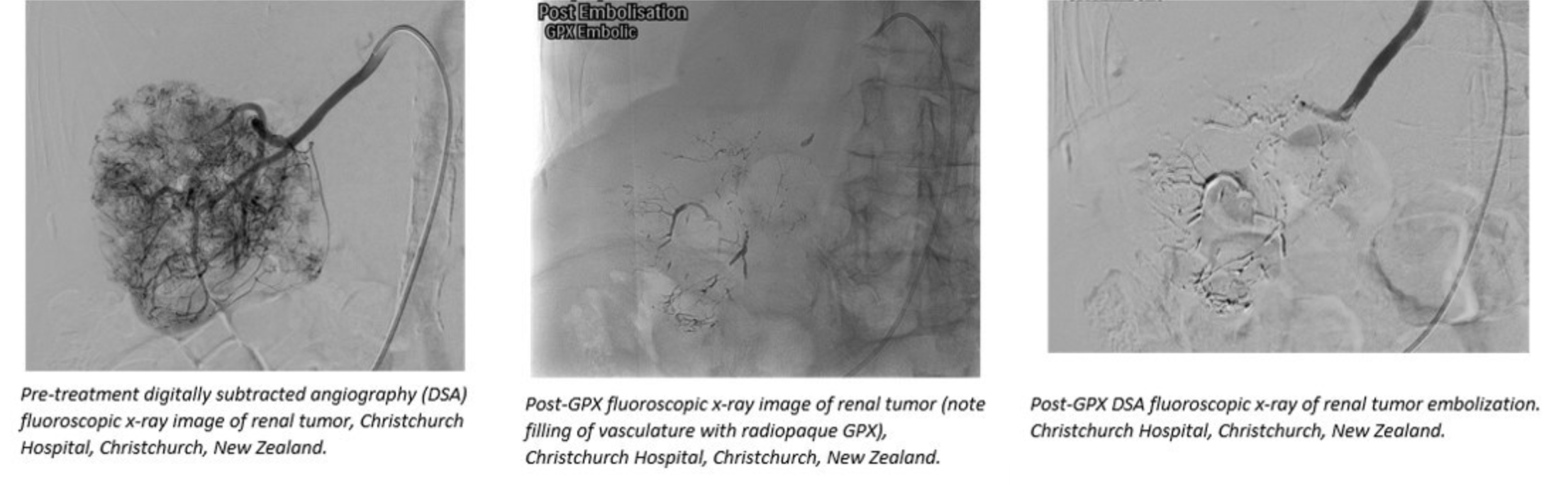 Investigational Embolic Device Selected for “Best of GEST” at Symposium
