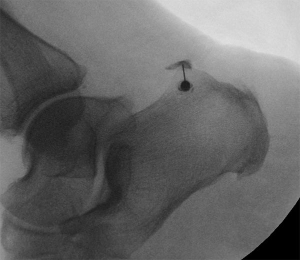 Fluoroscopically-guided retrocalcaneal bursa steroid injection efficient and effective