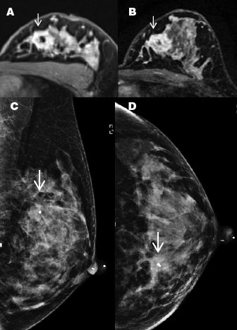 Half-dose gadobutrol shows breast lesions on 3T DCE breast MRI