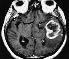Machine Learning Model Uses MRI Data to Predict Growth of Brain Tumors