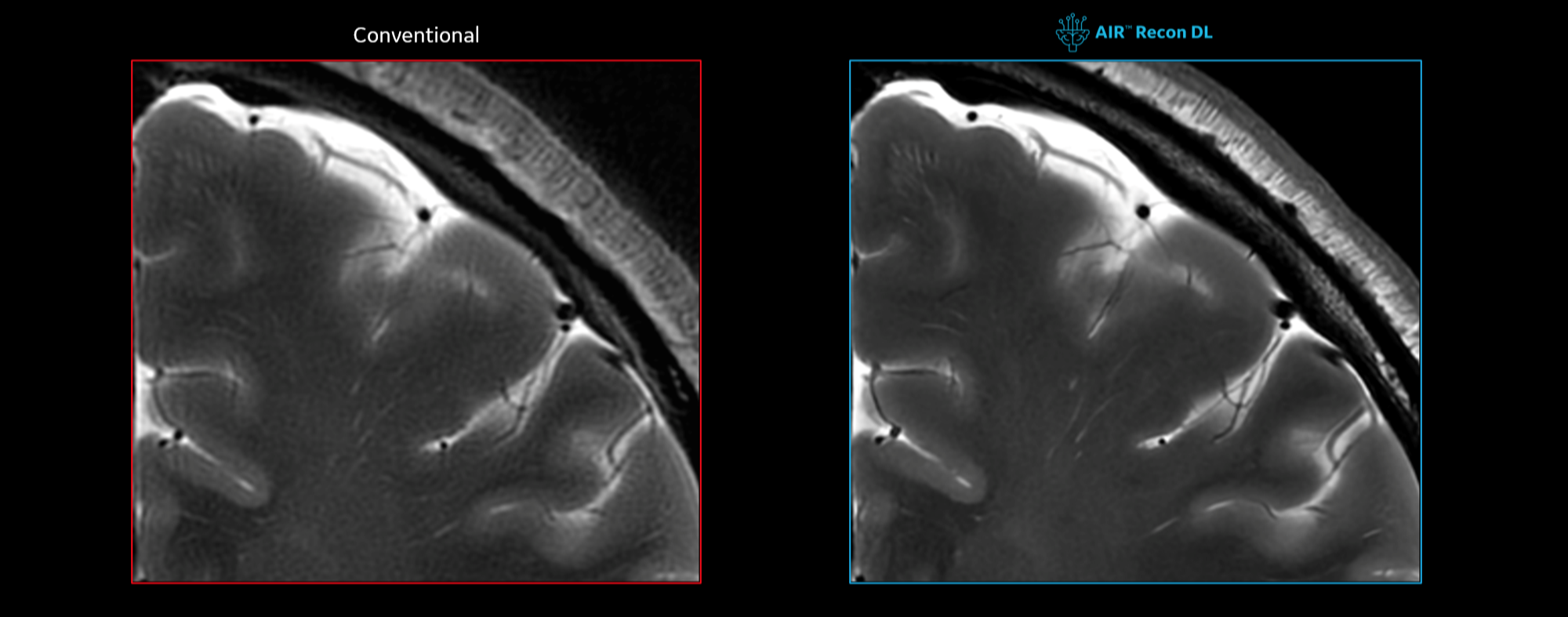 Deep-learning Image Reconstruction Cleared for Use on 7T MRI