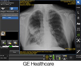 FDA clears GE Healthcare’s Critical Care Suite mobile DR AI algorithm