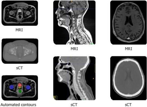 GE Healthcare Advances Precision Radiation Therapy Solutions