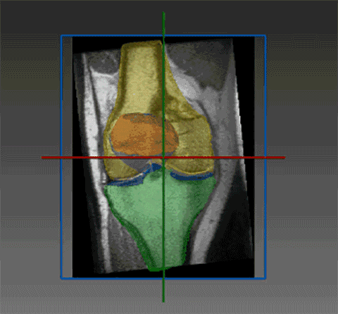 RSIP Vision Releases Articular Cartilage Segmentation Tool for MR Images