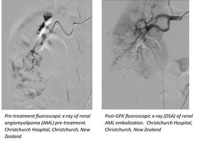 Novel Embolic Device Successfully Treats Complex Tumors