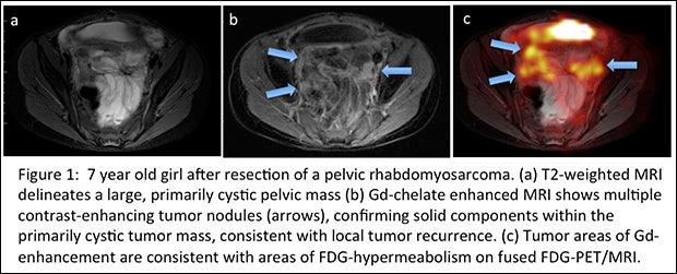 18F-FDG PET/MR exams don’t need gadolinium chelates for pediatric tumor evaluation