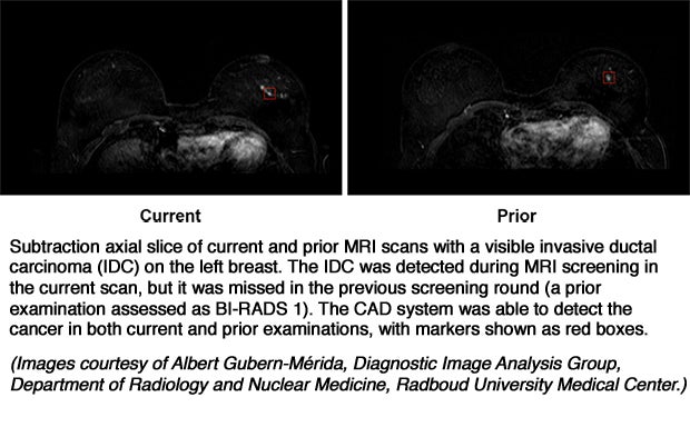 False negatives of breast MRI screening of high risk women: How CAD performs