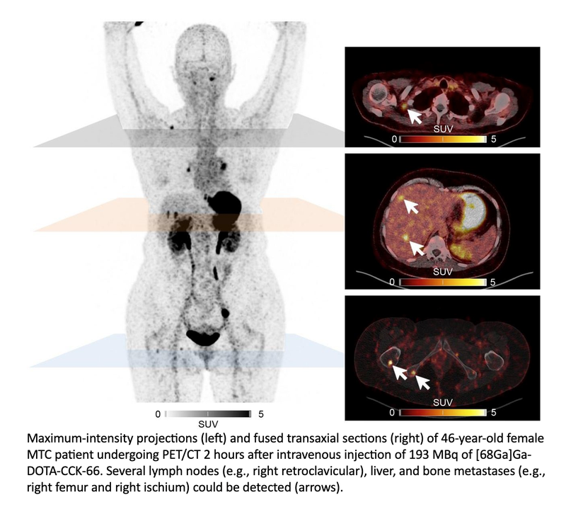 New PET Tracer Enhances Detection of Medullary Thyroid Cancer, Shows Theranostic Potential