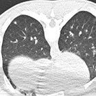 Study: One-quarter of Hospitalized COVID-19 Patients had Pulmonary Embolism