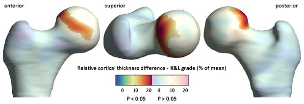 Potential of quantitative 3D analysis of CT bone images for hip osteoarthritis