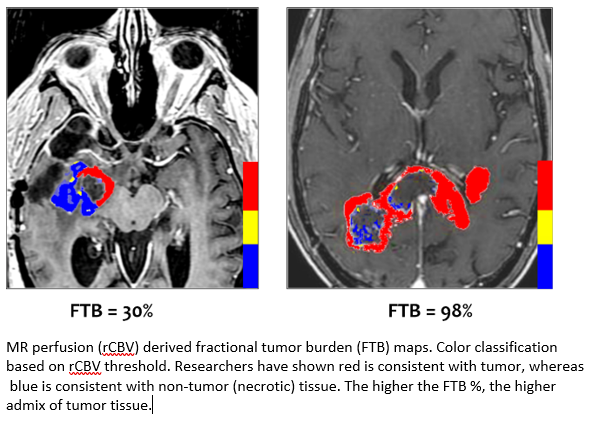 DSC MRI Perfusion Distinguishes Tumor from Radiation Necrosis