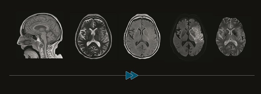 RSNA2019: Ultrafast brain MRI valid alternative to CT for emergent patients with non- traumatic neurological symptoms