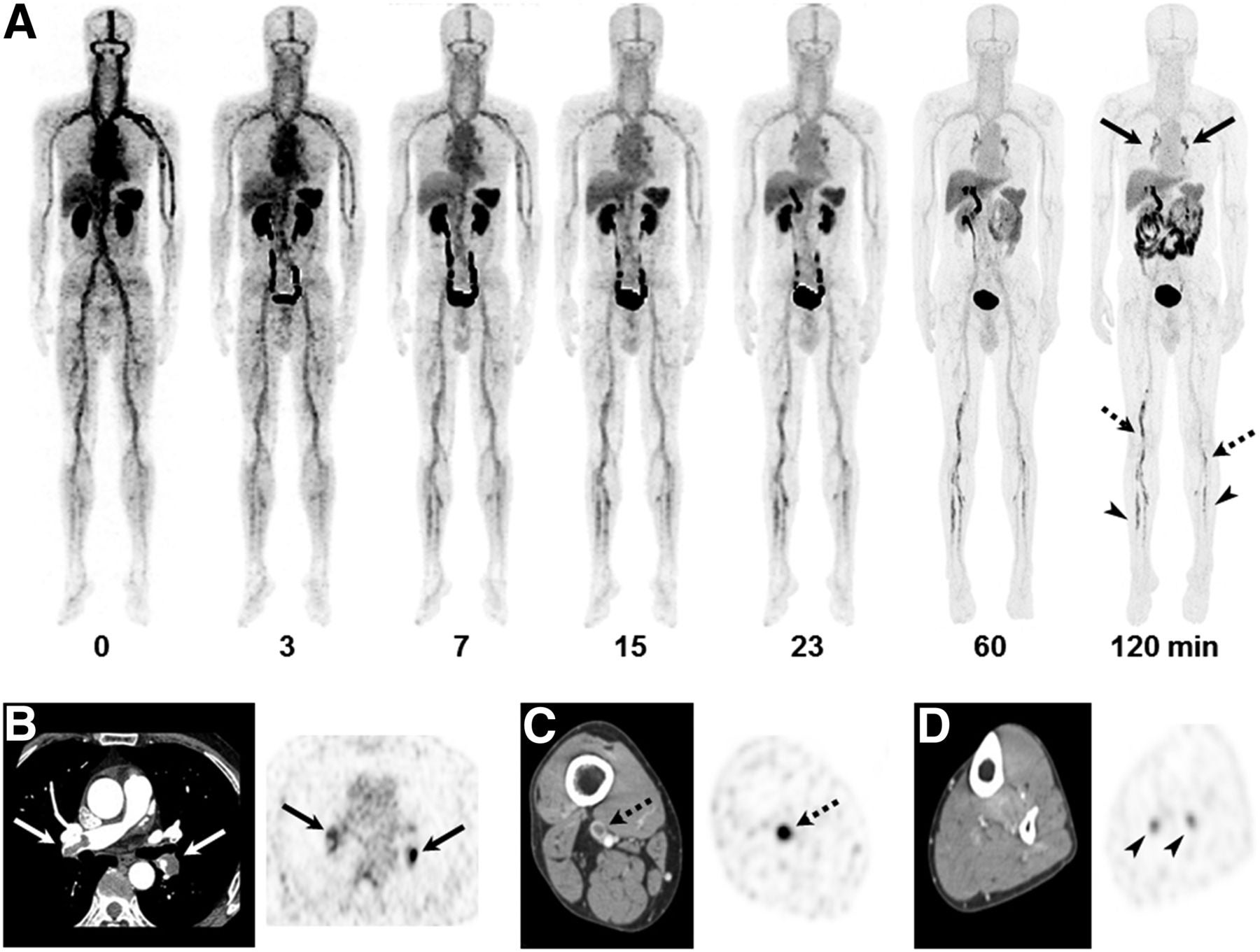 Novel PET/CT imaging agent for acute venous thromboembolism is safe and effective