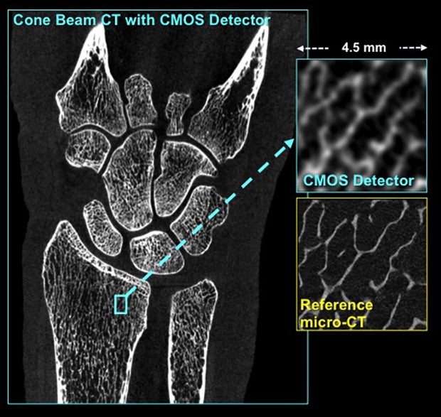 Diagnosing osteoarthritis at early stages with novel high-resolution cone-beam CT