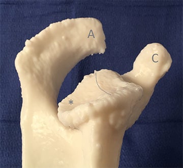3D printed models of glenoid can aid shoulder arthroplasty