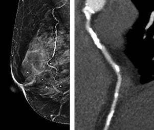 Breast arterial calcification: Indicator of coronary artery calcification?