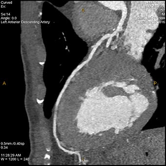 Practical Guide Published for CT Fractional Flow Reserve