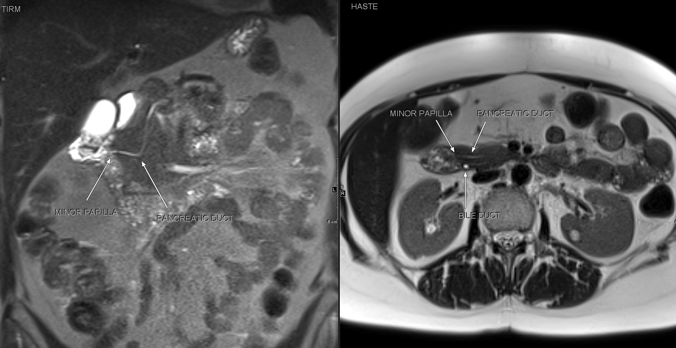 Phase II Pancreatic Cancer Study Cleared to Proceed by US FDA