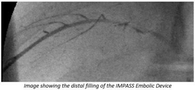 Embolic Device Shows Promise for Treating Neurovascular Subdural Hematomas