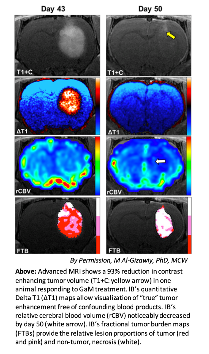 Phase I Trial to Evaluate Safety, Efficacy of Gallium Maltolate for Glioblastoma Multiforme