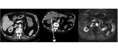 Cryoablation Successfully Treats Kidney Tumors