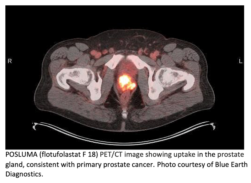 NCCN Adds POSLUMA to Clinical Practice Guidelines in Oncology for Prostate Cancer