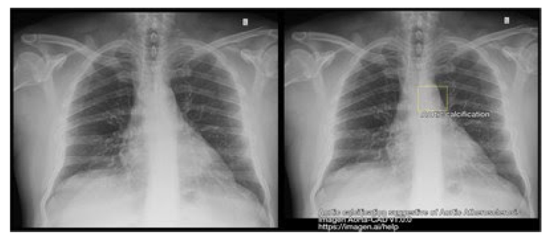Imagen Gets FDA Nod for Aorta-CAD