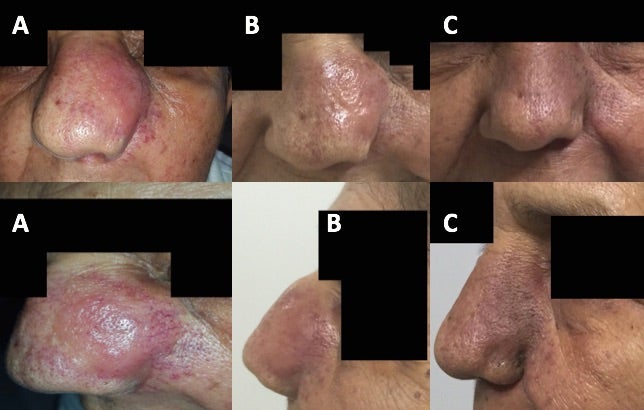 Radiotherapy Treatment in Nasal Diffuse Large B-Cell Lymphoma: A Case Report