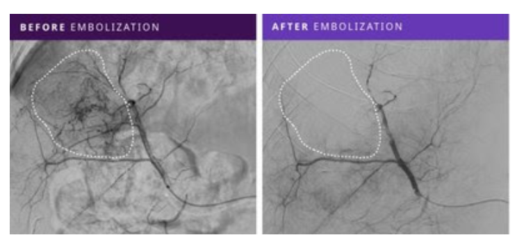 Instylla Performs First-In-Human PEG-based Liquid Embolic in Treating Hypervascular Tumors