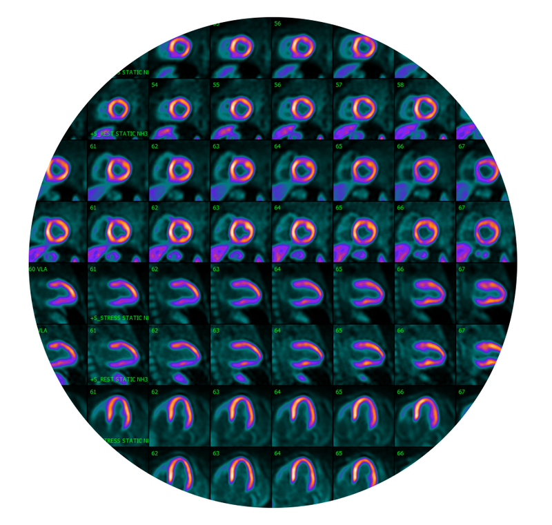SNMMI, ASNC Letter Leads to Aetna Coverage Reversal for Cardiac PET/CT