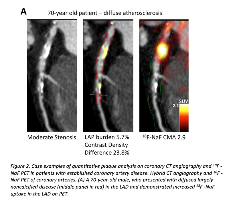 PET/CT AI Model Could Predict Heart Attacks