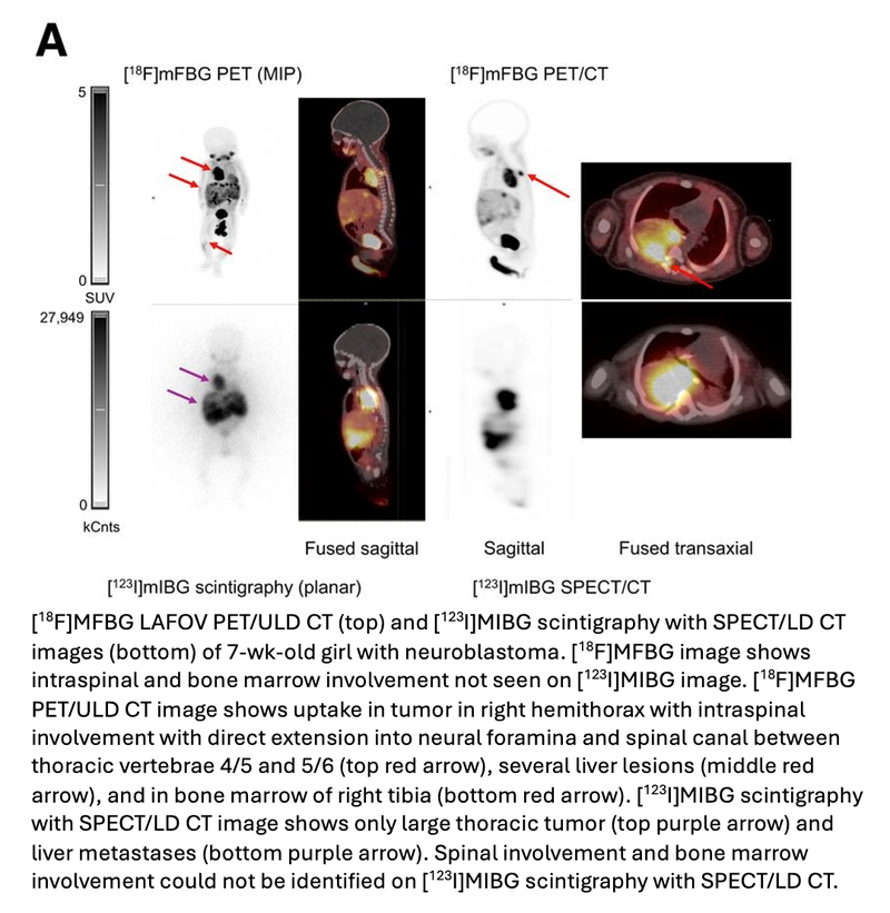 Molecular Imaging Technique Accurately Detects Neuroblastoma in Children With Short Scan Time, No Anesthesia