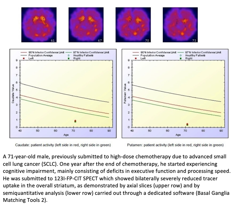 Nuclear Medicine Evaluates Biological Changes That Cause Chemo-Brain