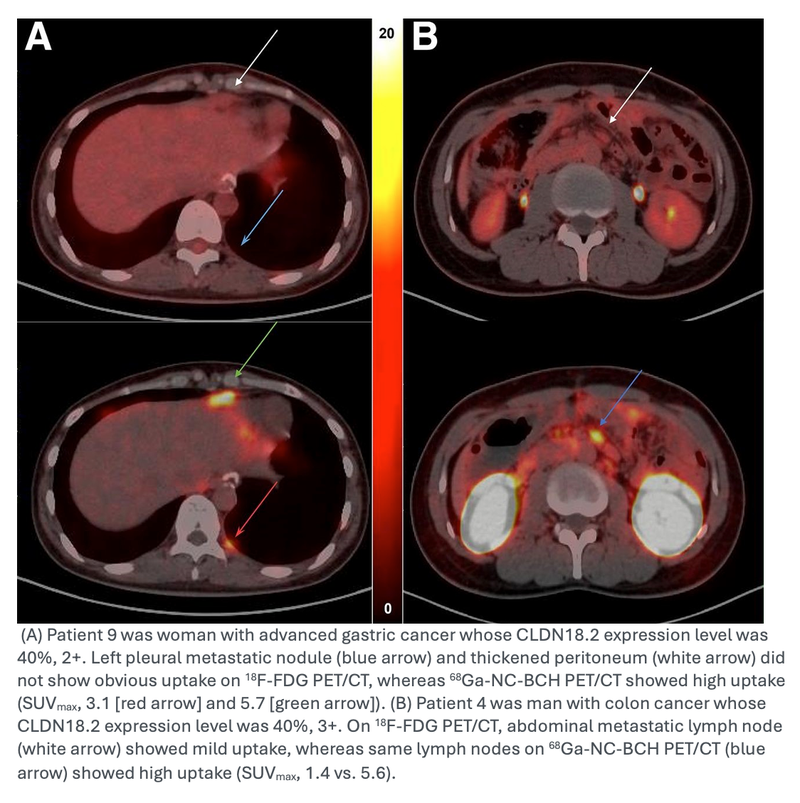 New Radiotracer Enables Same-Day Imaging of Gastrointestinal Cancer Biomarker, Identifies Targeted Therapy Candidates