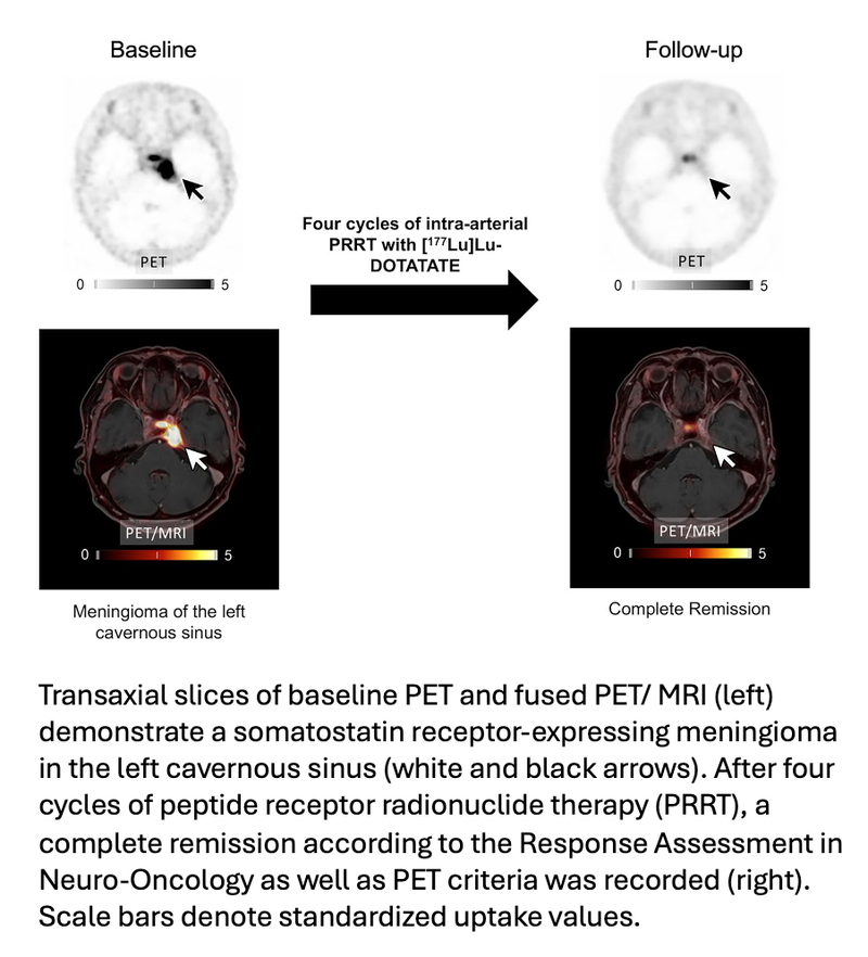Intrarterial Radionuclide Therapy Effective and Safe for Advanced Meningioma Patients