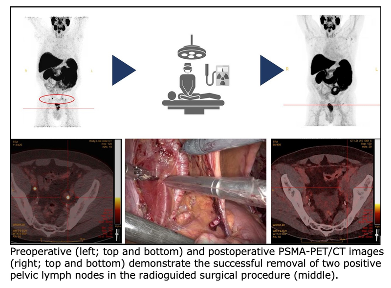 Radioguided Surgery Detects and Removes Metastatic Lymph Nodes in Newly Diagnosed Prostate Cancer Patients