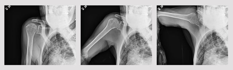 Emory Researcher Wins Awards with Prototype AI Tool and Dynamic Digital Radiography
