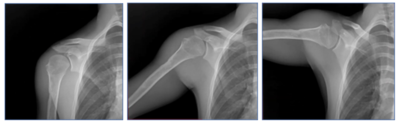 Dynamic Digital Radiography Better Quantifies Shoulder Injuries and Postoperative Improvement
