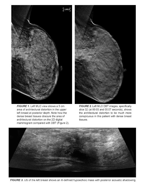 Infiltrating lobular carcinoma of the left breast