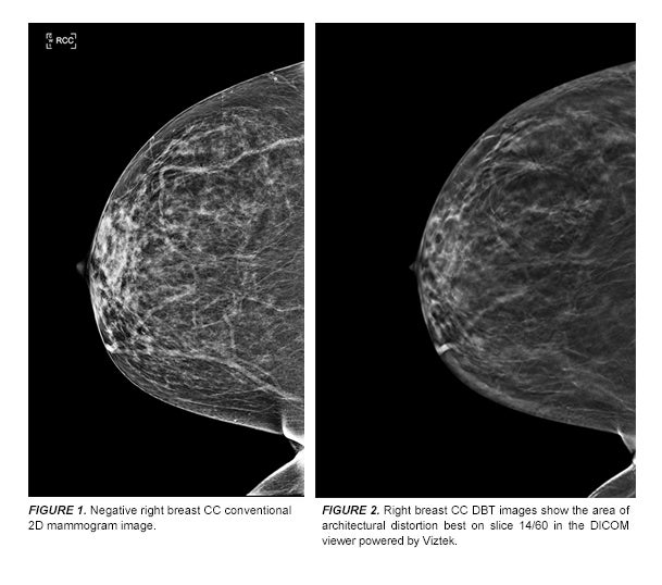 Radial scar associated with calcium oxalate crystals