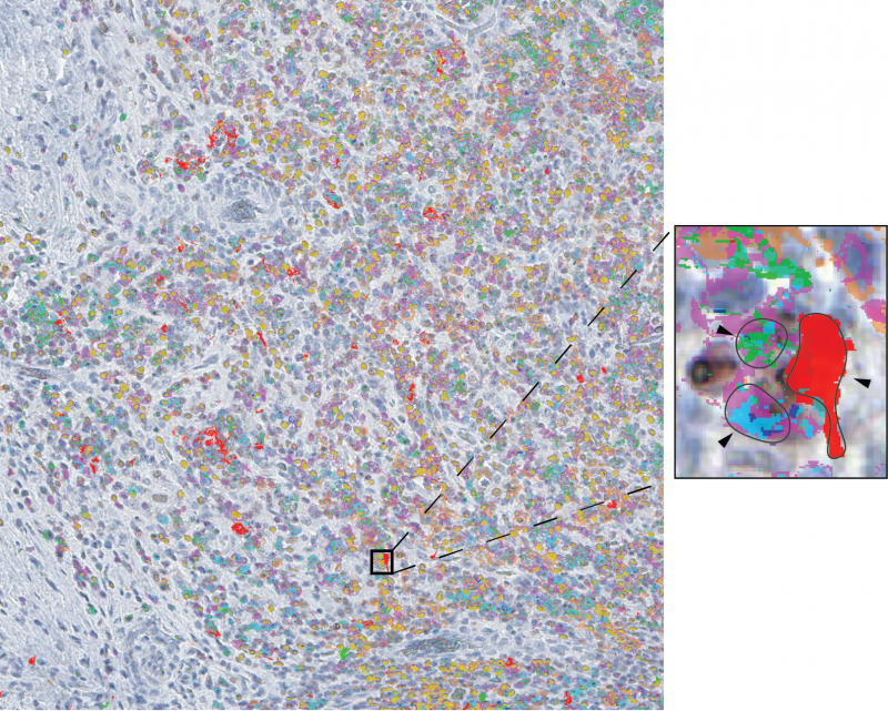 Trio of Immune Cells Vital for Liver Cancer Immunotherapy Response