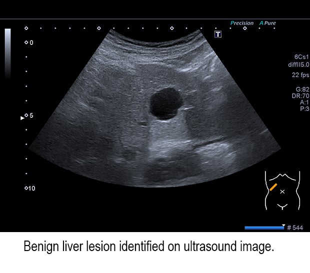 American College of Gastroenterology Updates Clinical Guidelines for Focal Liver Lesions