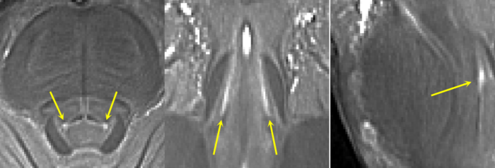 7T MRI Measures Changes in Brains of Patients with Parkinson’s Disease