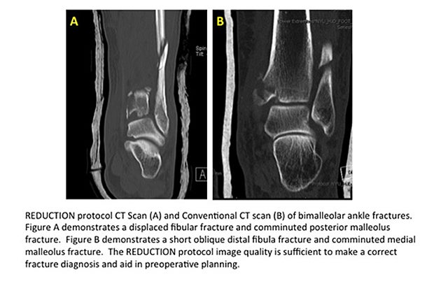 AAOS 2016: Ultra-low dose CT scans successfully detect fractures
