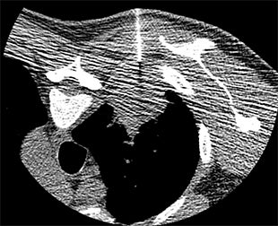 Feasibility and benefits of implementing a low-dose CT-guided lung biopsy protocol