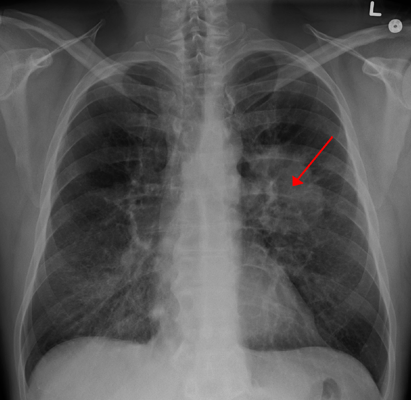 Risk Model-Based Strategies Lead to More Cost-Effective Lung Cancer Screening
