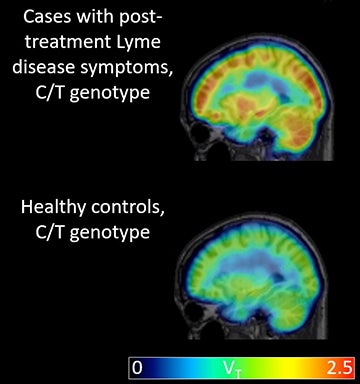 PET identifies neuroinflammation marker in post-Lyme disease syndrome