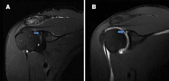 MR arthrography recommended for post-operative shoulder imaging
