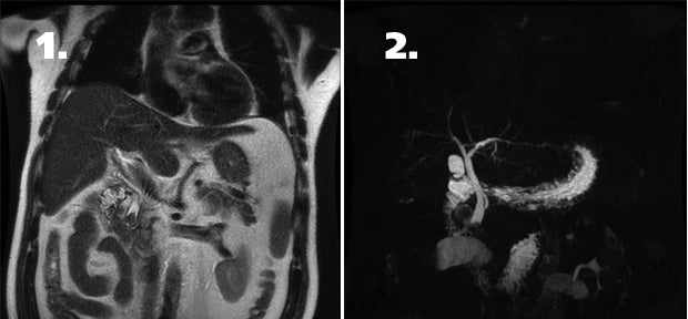 Abbreviated MRCP for choledocholithiasis recommended for ED patients