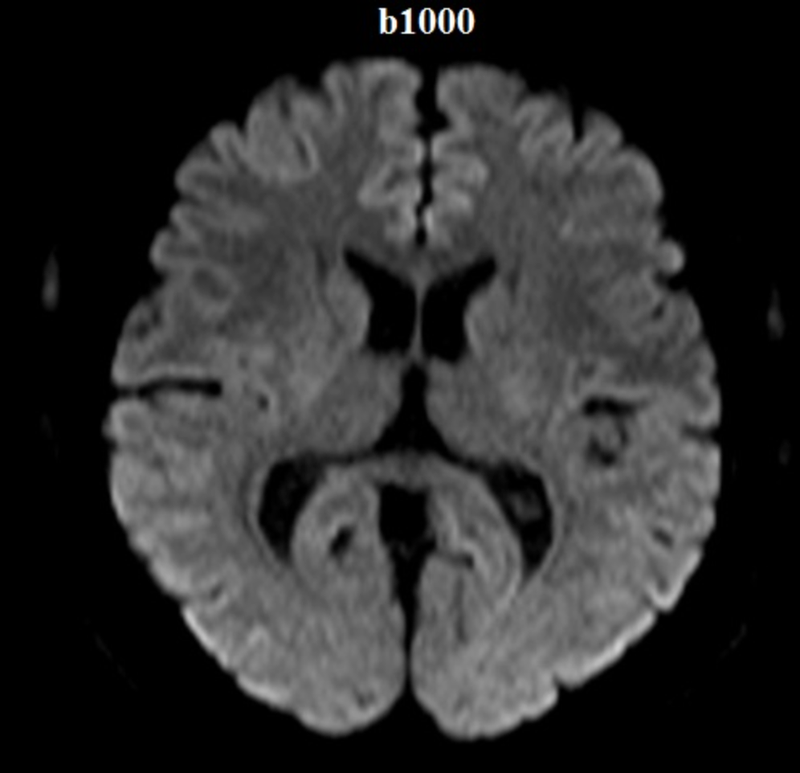 QIBA, CaliberMRI Announce First DWI MRI Conformance Certification